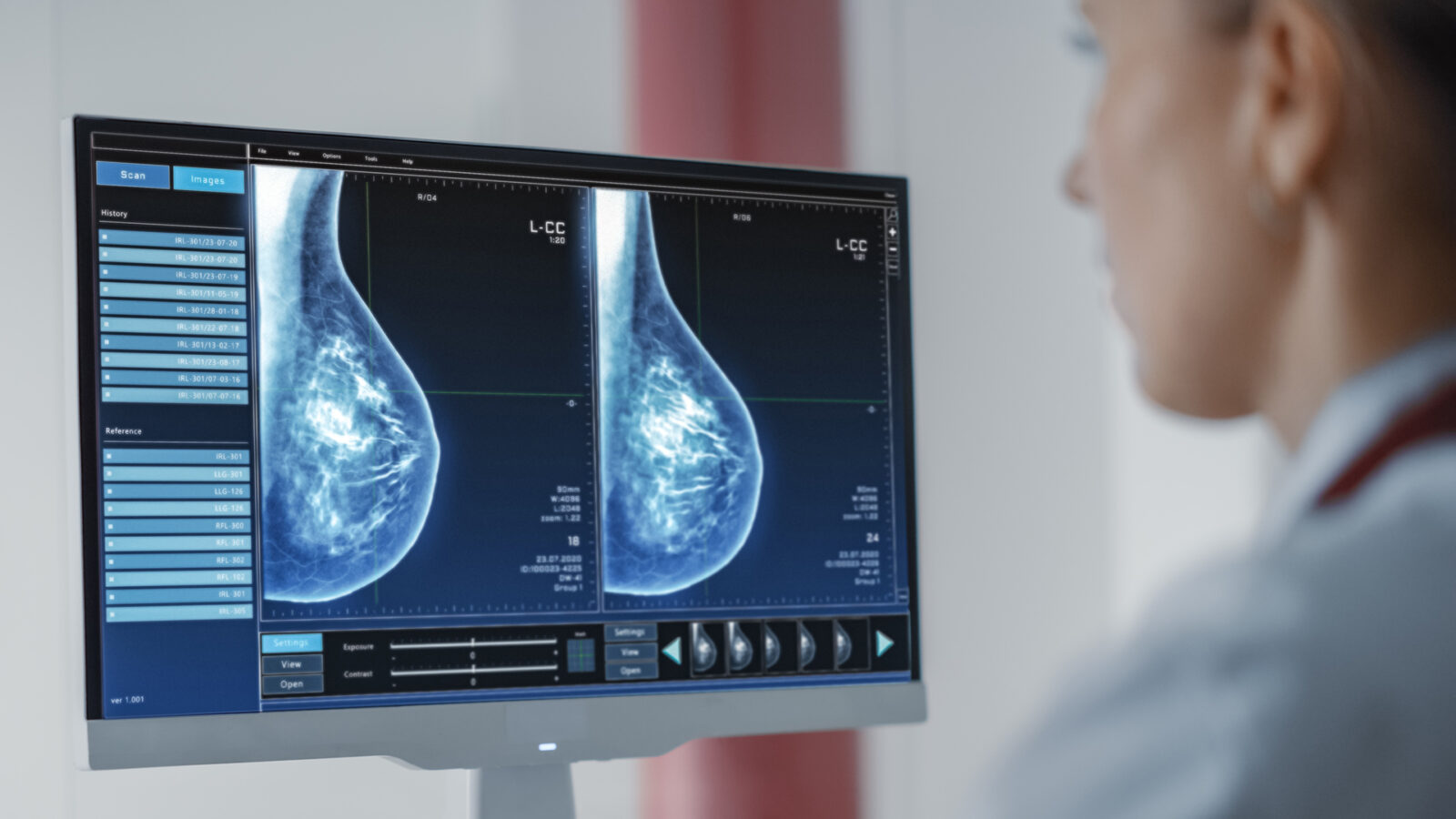 IA contra el cáncer de mama en tres frentes de atención