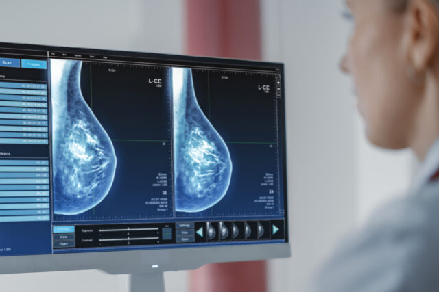 IA contra el cáncer de mama en tres frentes de atención
